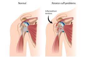 You have just read the article entitled sebab sakit tangan sebelah kiri. Memahami Mengenai Bahu