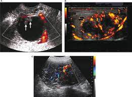 To evaluate the prevalence and significance of abnormal ovarian findings in asymptomatic postmenopausal women, screening for ovarian cancer with color doppler ultrasound was performed. Ultrasound Imaging Of Ovarian Cancer Chapter 22 Ultrasonography In Gynecology