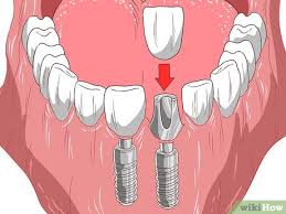 If you are annoyed thinking of putting on the metal braces, several discreet teeth straightening solutions are there lingual braces are there to put on the back of your teeth and hence they are almost invisible. How To Straighten Your Teeth Without Braces With Pictures