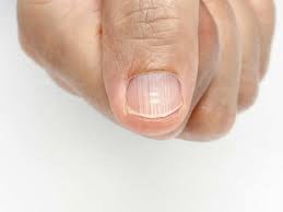 nails infections anemia psoriasis