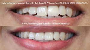 Pin On Much Does A Smile Makeover Cost