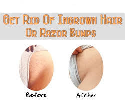 What do ingrown hairs look like? How To Get Rid Of Razor Bumps Overnight Kobo Guide