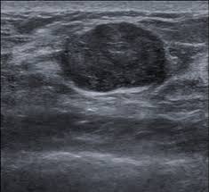 Fibroadenoma Gynecology Medbullets Step 2 3