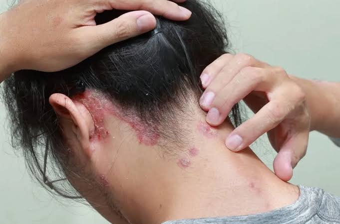 Dealing with Psoriasis - Nigel Russell | NJR Hair Blog