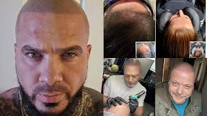 Empowerment Ink Scalp Micropigmentation