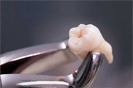 Maybe you would like to learn more about one of these? Effected Tooth Removal In Chennai Wisdom Teeth Removal Surgery In India