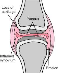 Integrative medicine is an approach to medical care that combines standard medicine with cam practices that have shown through science to be safe and effective. Pannus Definition Of Pannus By Medical Dictionary
