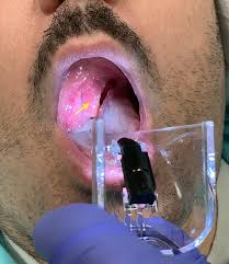 Image result for Uvulitis