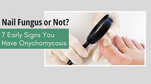 Image result for onychomycosis