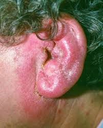 Image result for Acute Otitis Externa