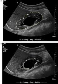 Sonographic Grading Of Renal Parenchymal Changes And Its Comparision With  Estimated Glomerular Filtration Rate (Egfr) Using Modi