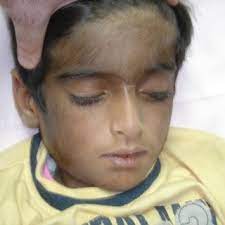 Men typically display darker, more coarse facial hair compared to women. Pdf A Case Report Featuring A Young Boy Presenting With Excessive Hair Growth Red Colored Urine