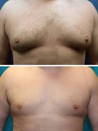 Image result for Gynecomastia
