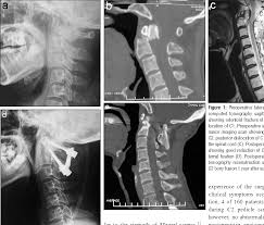 Figure 1 From C1 C2 Pedicle Screw Fixation For Treatment Of Old Odontoid Fractures Semantic Scholar