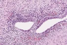 If one in 10 women have it, you'd think that everybody would be talking about it. Endometriosis Glowm