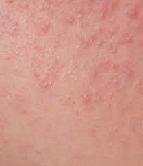 Please don't search and drive lol. Is It Milia A Wart Or Worse Here S What Could Be Residing On Your Face Project Vanity