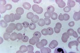 Unbehandelt endet sie meist tödlich. Malaria Deximed