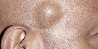 Kemudian masak daging selama 5 menit. Mengenal Penyakit Lipoma Dari Penyebab Hingga Cara Mengatasinya Merdeka Com