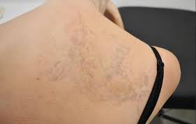 Laser tattoo removal is performed with a high level of skill and knowledge, and the results speak for themselves. Some Of 7 Most Frequently Asked Questions From Tattoo Removal Review Toowoomba