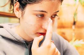 Image result for ekzema face