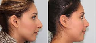 Rtkjejkt Rhinoplasty Recovery Nose Surgery Nose Job