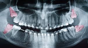 They can be the source of great discomfort for many people. Wisdom Teeth Pictures Symptoms Surgery Pain Relief Ask The Dentist