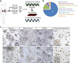 Different kinds of kidney cancer. An Organoid Biobank For Childhood Kidney Cancers That Captures Disease And Tissue Heterogeneity Nature Communications