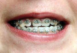 Why Diy Braces Are Actually A Terrible Terrible Idea Diy Braces Braces Braces Colors