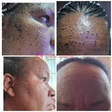 Anyone else have skin tag issues???