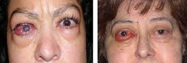 Apr 21, 2021 · graves' eye disease, also called graves' ophthalmopathy or thyroid eye disease, is a problem that usually develops in people with an overactive thyroid caused by graves' disease (see brochure on graves' disease). Graves Disease An Overview Sciencedirect Topics