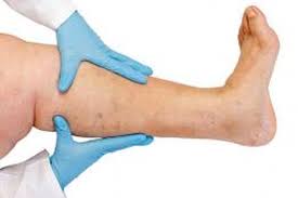 The arteries carry blood from the heart to the limbs; Mengenal Trombosis Si Pembunuh Senyap