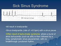 Image Result For Sick Sinus Syndrome Ecg