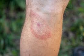 Image result for infected tick bite