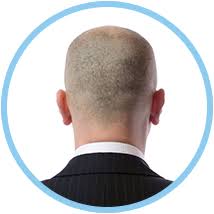 Hair Transplant By Fut Method Ilhan Serdaroglu