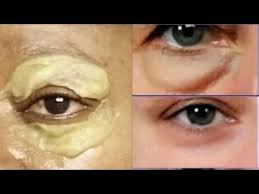 Apply Once A Day Remove Eye Bag And Puffy Eye Youtube In 2020 Eye Bags Remove Eye Bags Puffy Eyes