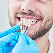 Transform Your Smile with Porcelain Dental Veneers in Arlington, WA