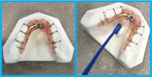 Maybe you would like to learn more about one of these? Schwartz Lower Expander Instructions At Smile Appeal Orthodontics