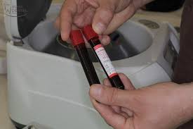 Prf strives for excellence as a service provider of engineering, construction and maintenance, throughout the sector of combustible gases. Information On The Process For Prf Platelet Rich Fibrin 38 Subadental