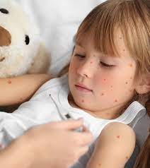 Acyclovir is also available as a cream. Top 16 Effective Home Remedies To Get Rid Of Chickenpox