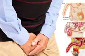 viêm tinh hoàn ở nam giới gây đau và sưng tinh hoàn