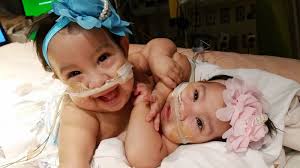 Having Hope and Faith: Inside Dramatic Surgery to Separate Conjoined Texas  Twins