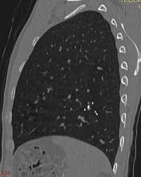 Image result for Broncholithiasis