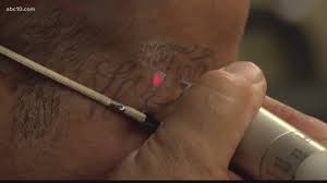 California skin & laser center our goal is to provide you with exceptional and safe cosmetic surgical and dermatologic care, at a reasonable price. Ex Gang Member Escapes Troubled Past Through Tattoo Removal Abc10 Com