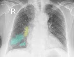Check spelling or type a new query. Pneumonia Knowledge Amboss