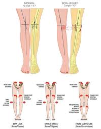 Image result for Genu Varum