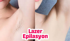 lazer epilasyon oncesi sonrasi epilasyon serum saglik