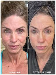 Saline Inhaler for Stuffy Nose Season Relief