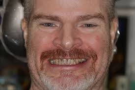 Advantages of ArchONE's Full Arch Implant System