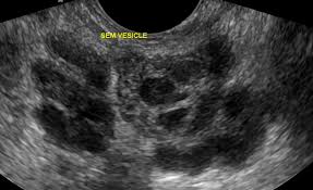 Image result for Seminal Vesicle