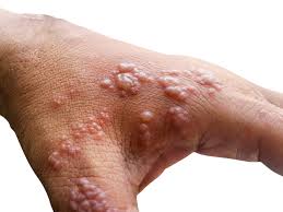 Image result for Pemphigoid